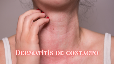 Dermatitis de contacto por uso de cosméticos.